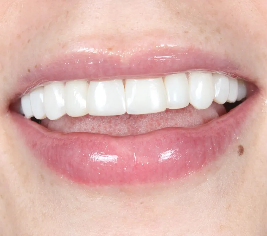 Después: dientes de enfrente sin espacio, con forma y color parejos