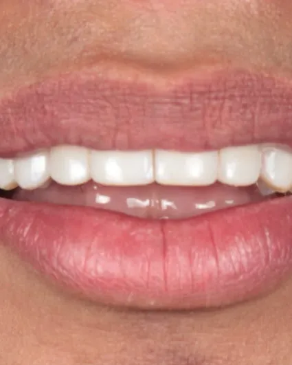 Sonrisa terminada, vista de frente