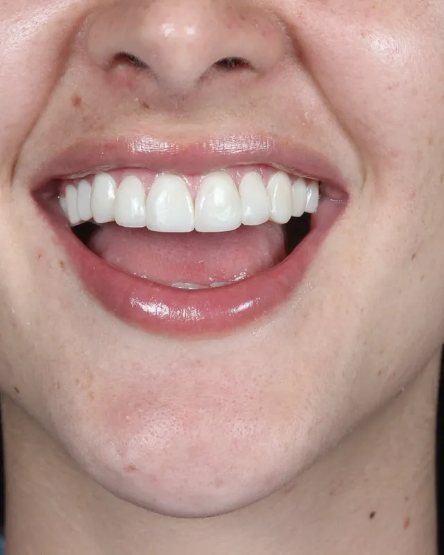 Paciente sonriendo con su diseño de sonrisa