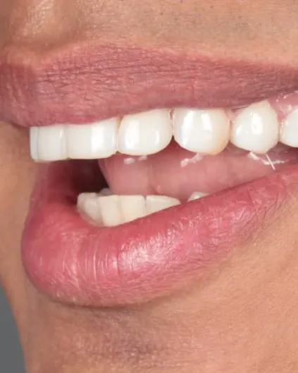 Sonrisa terminada, vista lateral
