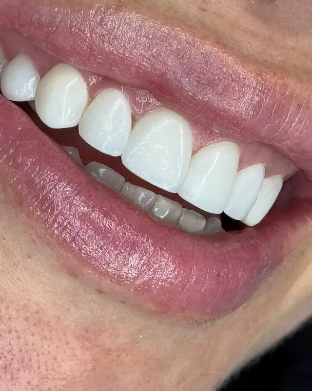 Detalle de forma y brillo en dientes superiores
