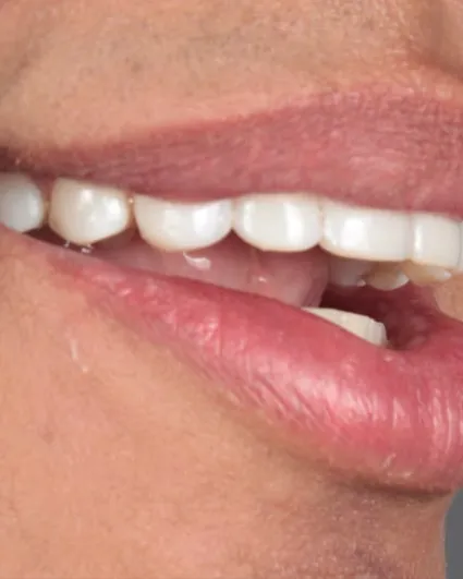 Sonrisa terminada, vista lateral