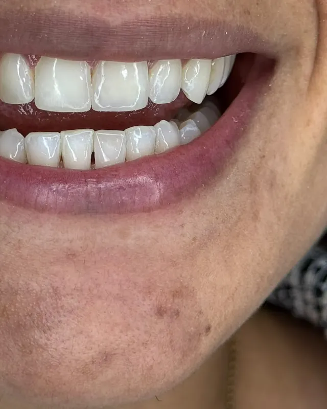 Dientes superiores e inferiores terminados